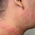 Gejala Eksim Dan Cara Perawatannya Yang Tepat Panduan Lengkap Untuk Kulit Sehat