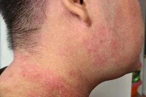 Gejala Eksim Dan Cara Perawatannya Yang Tepat Panduan Lengkap Untuk Kulit Sehat